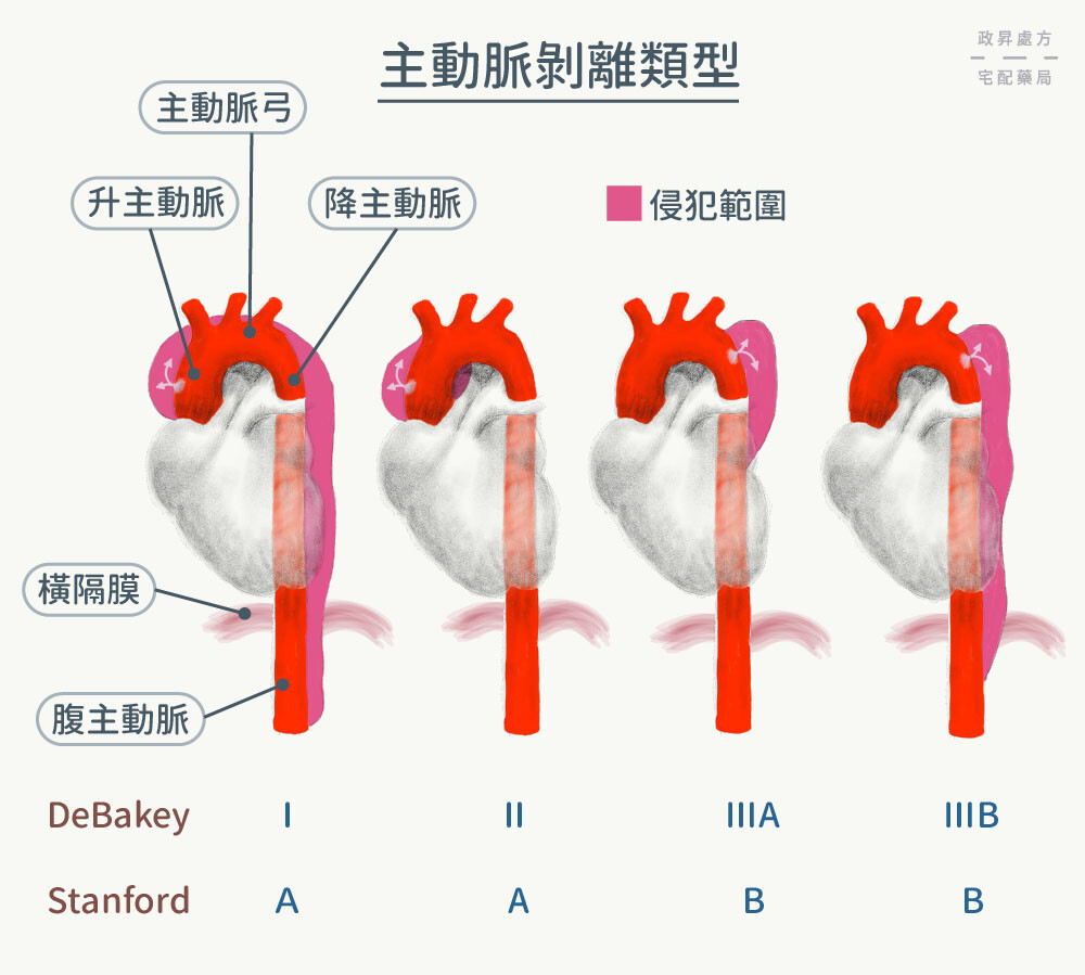 做好3件事，預防致命的主動脈剝離 | iHealth